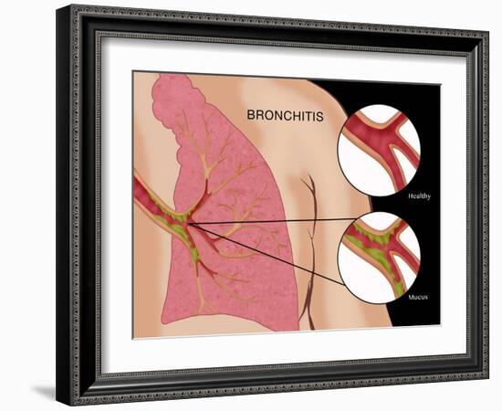 Bronchitis-Monica Schroeder-Framed Giclee Print