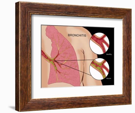 Bronchitis-Monica Schroeder-Framed Premium Giclee Print