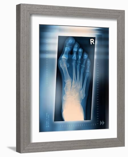 Bunion, X-ray-Miriam Maslo-Framed Photographic Print