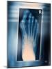 Bunion, X-ray-Miriam Maslo-Mounted Photographic Print