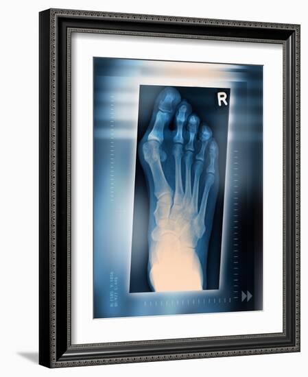 Bunion, X-ray-Miriam Maslo-Framed Photographic Print