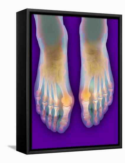 Bunions, X-ray-Science Photo Library-Framed Premier Image Canvas