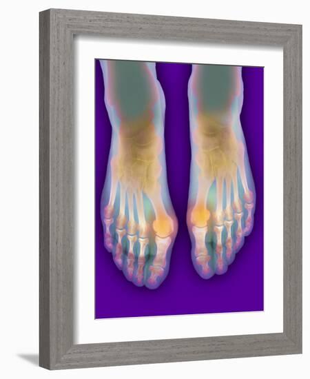 Bunions, X-ray-Science Photo Library-Framed Photographic Print