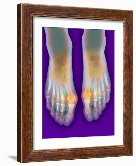 Bunions, X-ray-Science Photo Library-Framed Photographic Print