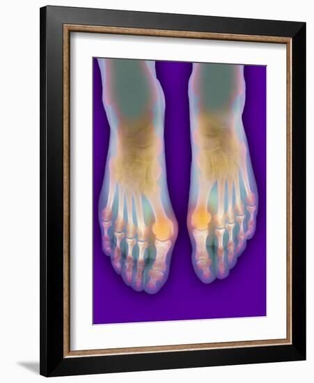 Bunions, X-ray-Science Photo Library-Framed Photographic Print