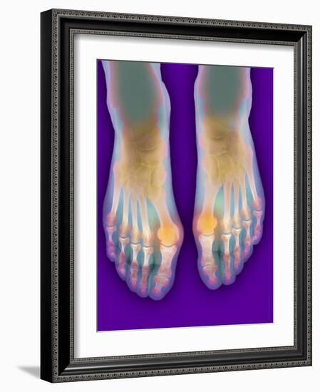 Bunions, X-ray-Science Photo Library-Framed Photographic Print