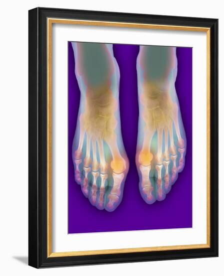 Bunions, X-ray-Science Photo Library-Framed Photographic Print