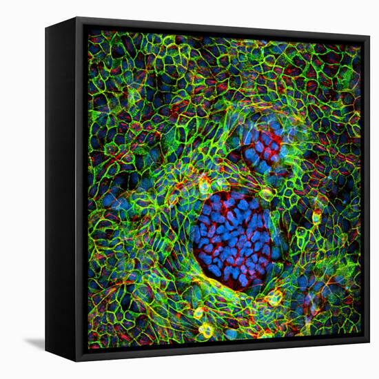 Cancer Cells, Light Micrograph-Science Photo Library-Framed Premier Image Canvas