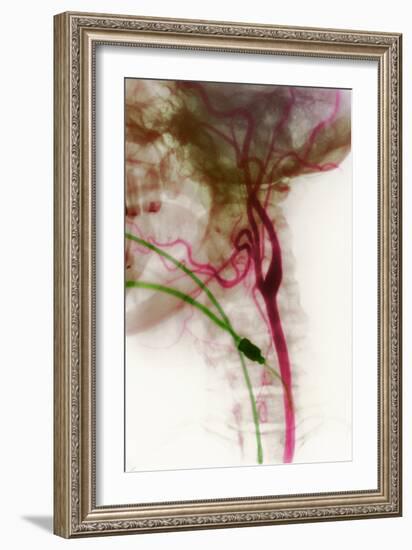 Carotid Arteries, X-ray-null-Framed Photographic Print