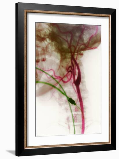 Carotid Arteries, X-ray-null-Framed Photographic Print