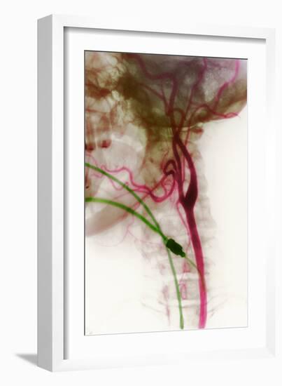 Carotid Arteries, X-ray-null-Framed Photographic Print