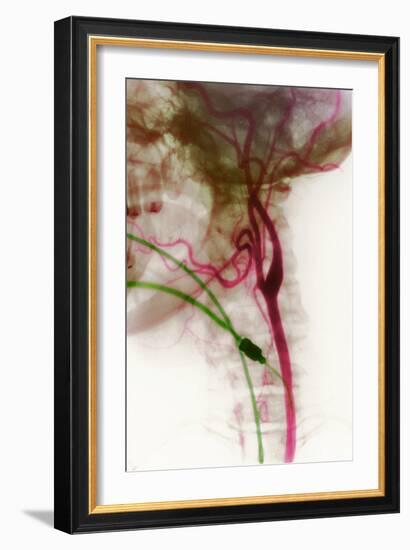 Carotid Arteries, X-ray-null-Framed Photographic Print