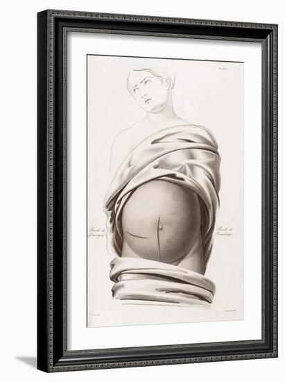 Cesarean Section, Incisions, Illustration, 1822-Science Source-Framed Giclee Print