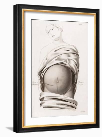 Cesarean Section, Incisions, Illustration, 1822-Science Source-Framed Giclee Print