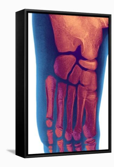 Child's Foot, X-ray-Du Cane Medical-Framed Premier Image Canvas