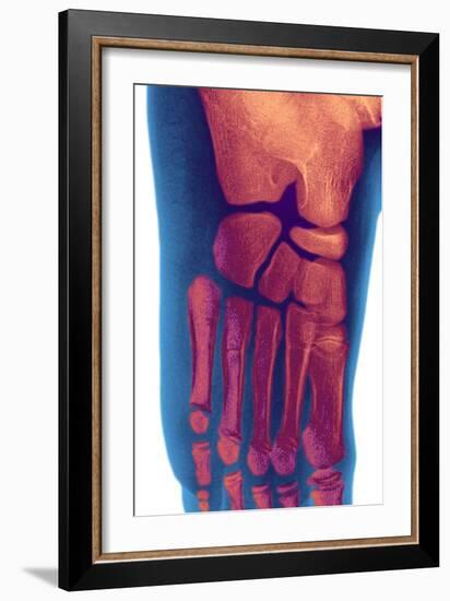 Child's Foot, X-ray-Du Cane Medical-Framed Photographic Print