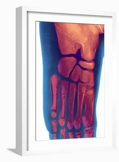 Child's Foot, X-ray-Du Cane Medical-Framed Photographic Print