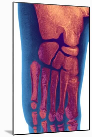 Child's Foot, X-ray-Du Cane Medical-Mounted Photographic Print