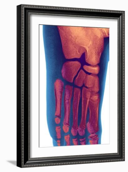 Child's Foot, X-ray-Du Cane Medical-Framed Photographic Print