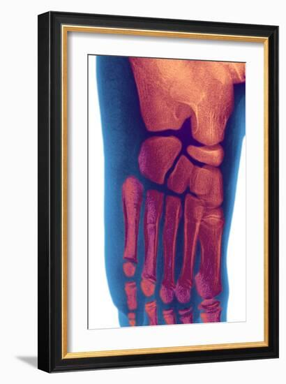 Child's Foot, X-ray-Du Cane Medical-Framed Photographic Print