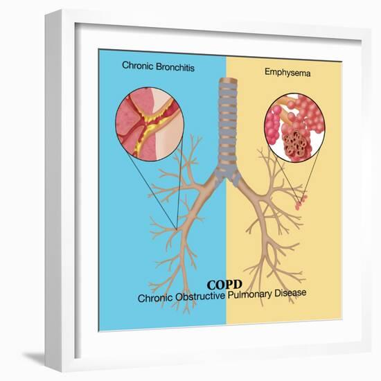 Chronic Obstructive Pulmonary Disease (COPD)-Monica Schroeder-Framed Giclee Print