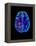 Col. MRI Scan of a Brain with Multiple Sclerosis-Science Photo Library-Framed Premier Image Canvas