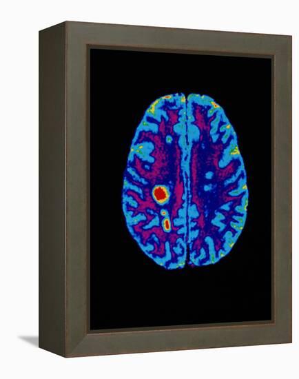 Col. MRI Scan of a Brain with Multiple Sclerosis-Science Photo Library-Framed Premier Image Canvas