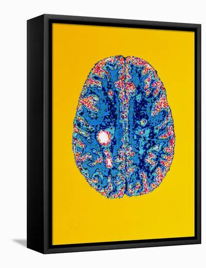 Col. MRI Scan of a Brain with Multiple Sclerosis-Science Photo Library-Framed Premier Image Canvas