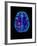 Col. MRI Scan of a Brain with Multiple Sclerosis-Science Photo Library-Framed Photographic Print