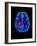 Col. MRI Scan of a Brain with Multiple Sclerosis-Science Photo Library-Framed Photographic Print