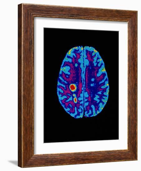 Col. MRI Scan of a Brain with Multiple Sclerosis-Science Photo Library-Framed Photographic Print