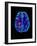 Col. MRI Scan of a Brain with Multiple Sclerosis-Science Photo Library-Framed Photographic Print