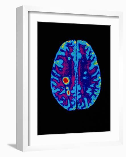 Col. MRI Scan of a Brain with Multiple Sclerosis-Science Photo Library-Framed Photographic Print