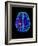 Col. MRI Scan of a Brain with Multiple Sclerosis-Science Photo Library-Framed Photographic Print