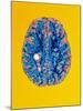 Col. MRI Scan of a Brain with Multiple Sclerosis-Science Photo Library-Mounted Photographic Print