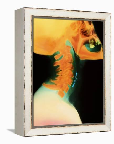 Col X-ray of Object Safety Pin Lodged In-Science Photo Library-Framed Premier Image Canvas