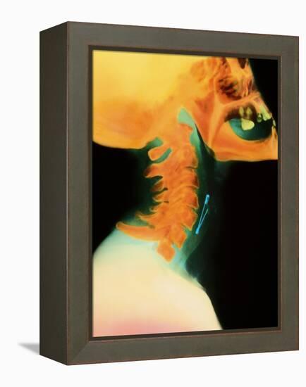 Col X-ray of Object Safety Pin Lodged In-Science Photo Library-Framed Premier Image Canvas