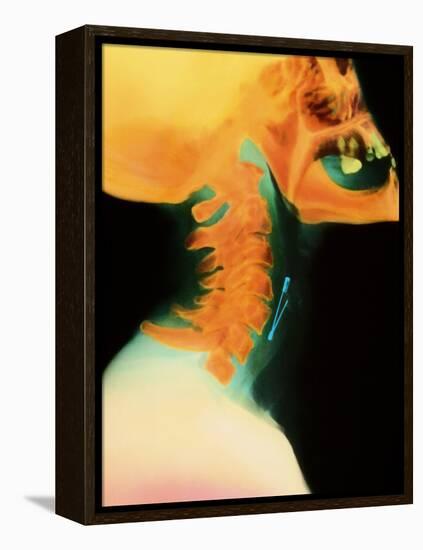 Col X-ray of Object Safety Pin Lodged In-Science Photo Library-Framed Premier Image Canvas