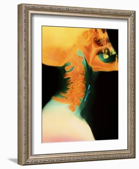 Col X-ray of Object Safety Pin Lodged In-Science Photo Library-Framed Photographic Print