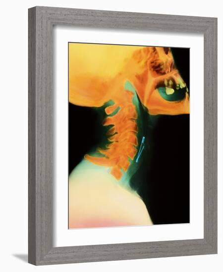 Col X-ray of Object Safety Pin Lodged In-Science Photo Library-Framed Photographic Print