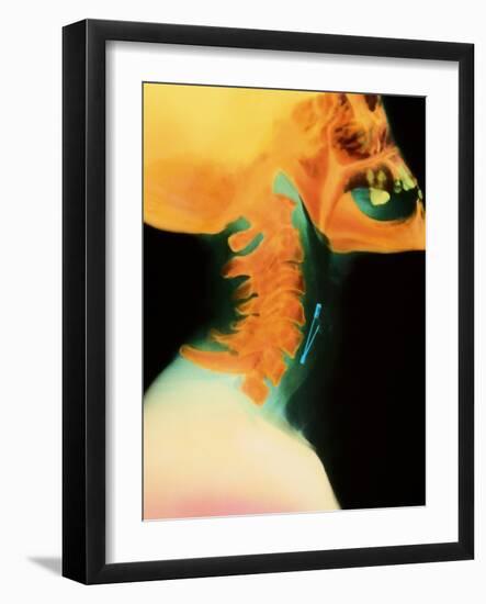 Col X-ray of Object Safety Pin Lodged In-Science Photo Library-Framed Photographic Print