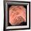 Colon Diverticulosis-David Martin-Framed Premium Photographic Print