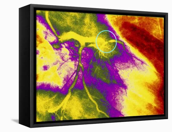 Colour Angiogram of Left Coronary Artery Stenosis-Mehau Kulyk-Framed Premier Image Canvas