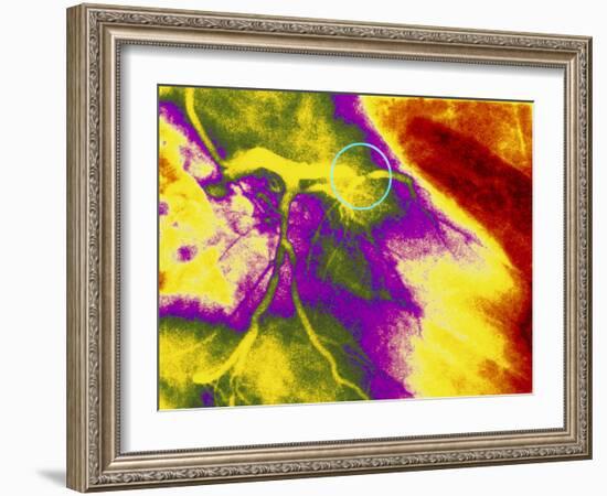 Colour Angiogram of Left Coronary Artery Stenosis-Mehau Kulyk-Framed Photographic Print