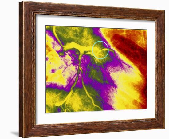 Colour Angiogram of Left Coronary Artery Stenosis-Mehau Kulyk-Framed Photographic Print