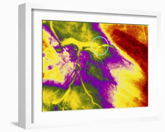 Colour Angiogram of Left Coronary Artery Stenosis-Mehau Kulyk-Framed Photographic Print