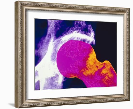 Colour X-ray of Upper Femur with Osteoporosis-PASIEKA-Framed Photographic Print
