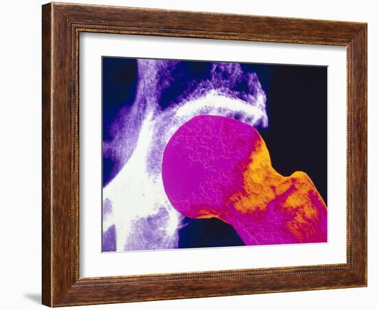 Colour X-ray of Upper Femur with Osteoporosis-PASIEKA-Framed Photographic Print