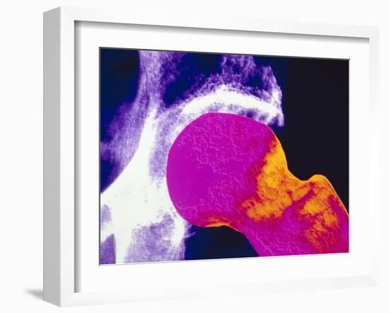 Colour X-ray of Upper Femur with Osteoporosis-PASIEKA-Framed Photographic Print