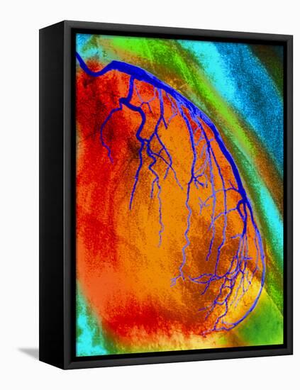 Coloured Angiogram of Coronary Artery of the Heart-Science Photo Library-Framed Premier Image Canvas